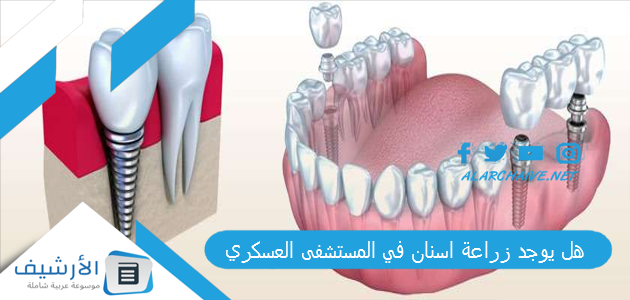 هل يوجد زراعة اسنان في المستشفى العسكري