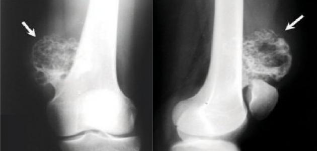 حالات شفيت من سرطان العظام