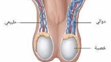 علاج دوالي الخصية طبيعيًا