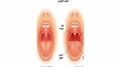 علاج التهاب اللوز في المنزل