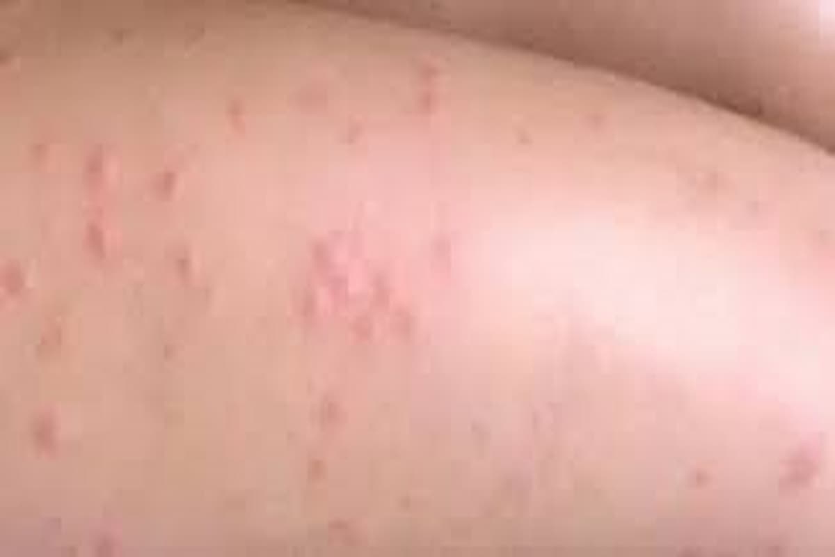 ما تفسير الحبوب الحمراء في المنام؟ 1 تفسير حلم حبوب في الوجه